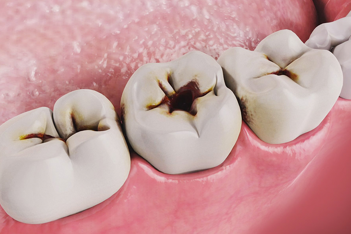 ¿Cómo eliminar las Caries Dentales?