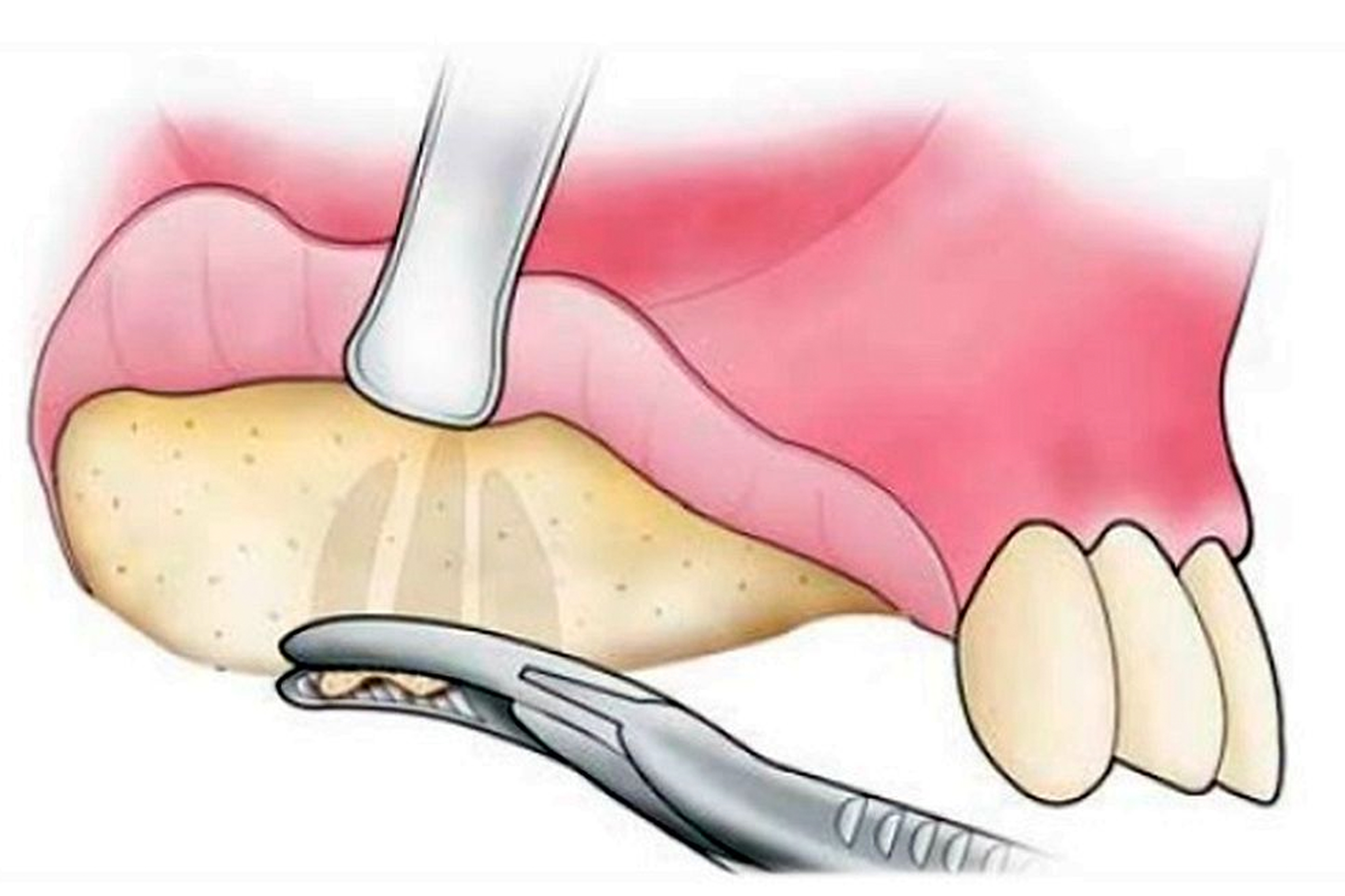 Cirugía y prótesis dentales