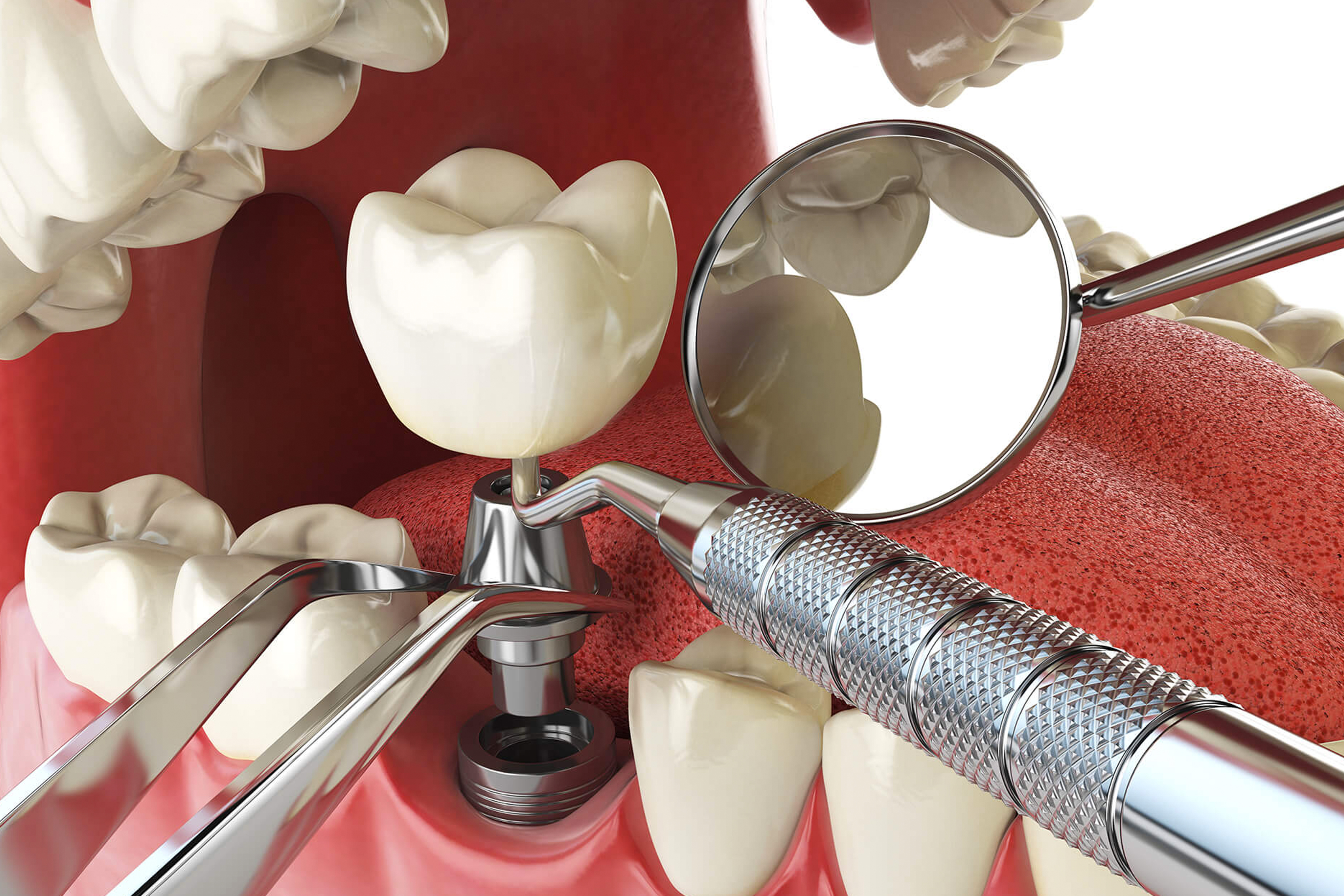 ¿Cómo realizar los implantes dentales?
